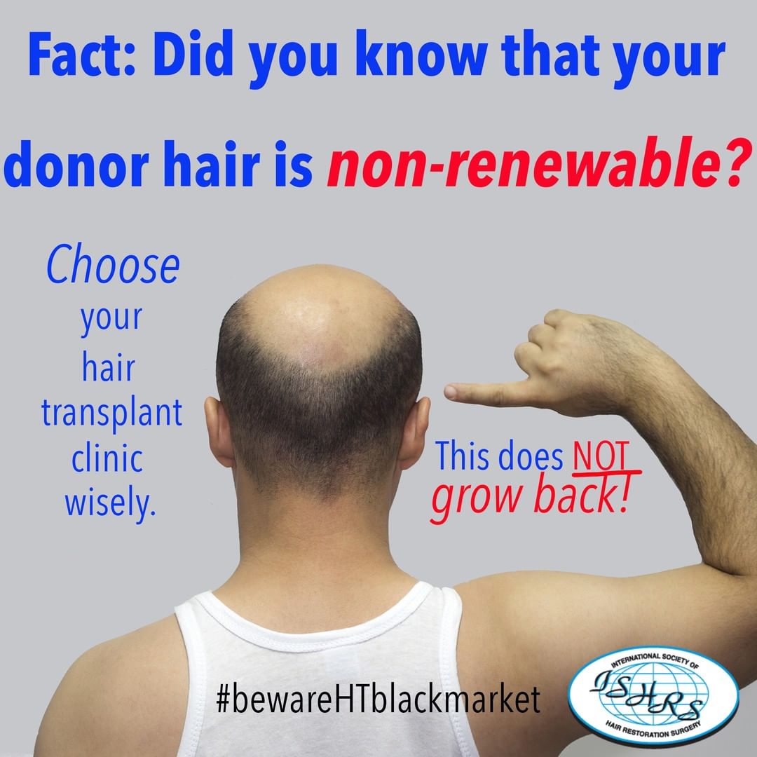 Hair transplantation
