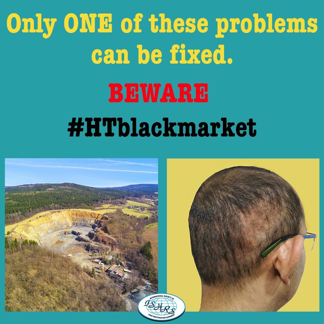 FUE hair transplant 