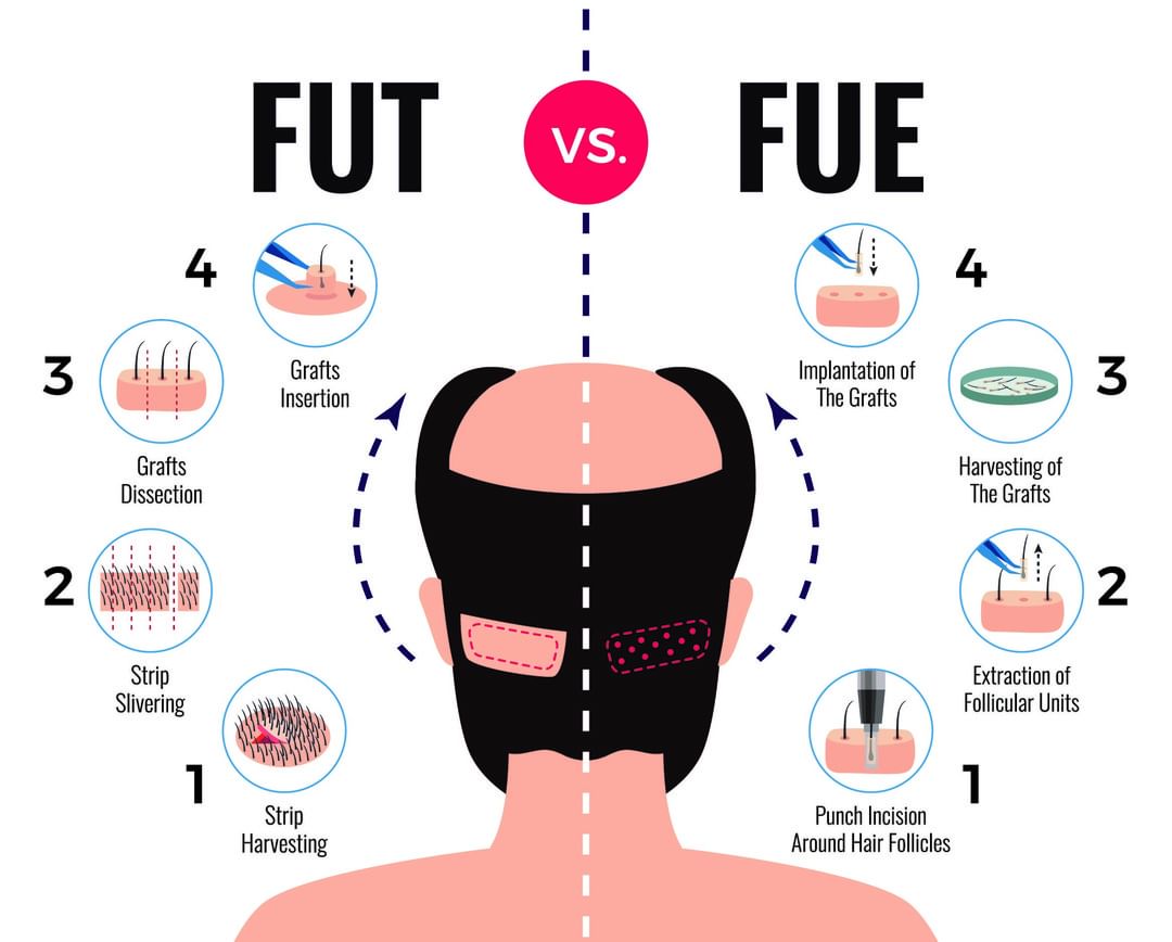 Can hair transplant 