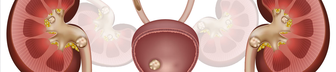 سمپوزیوم بین المللی سنگ های ادراری (ISU) banner ilikevents